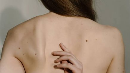Что будет, если содрать родинку, и как распознать опасное образование на коже